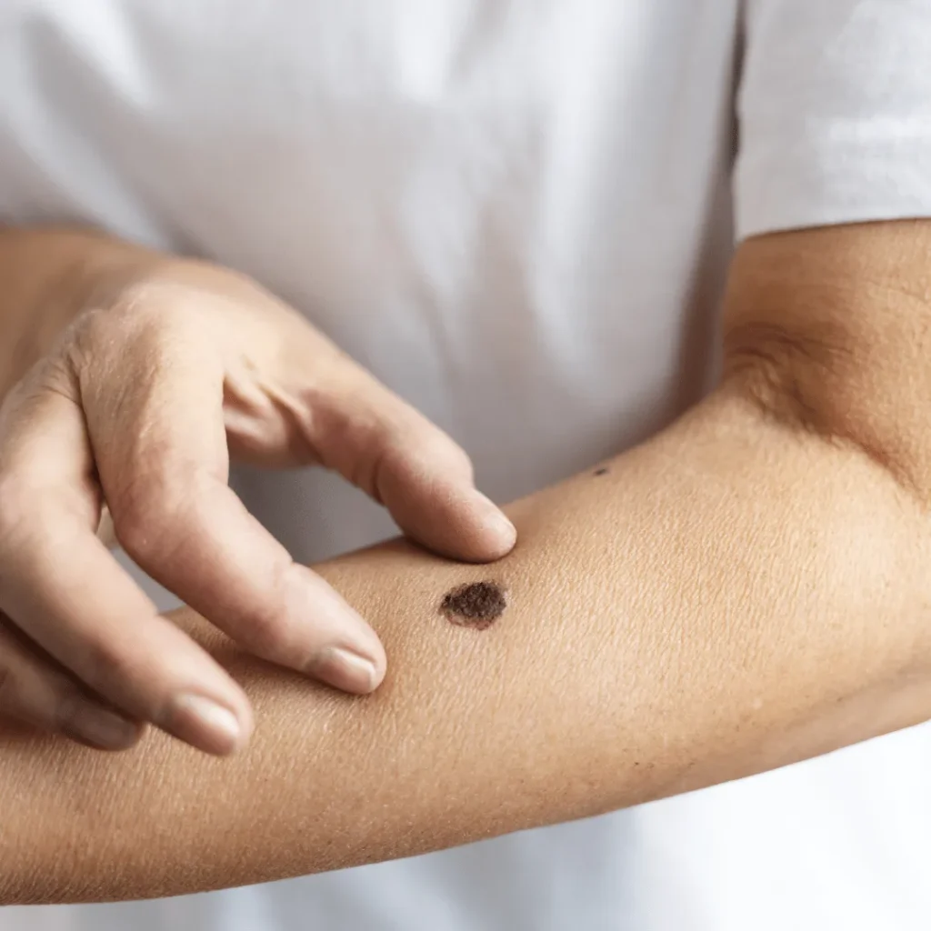 Seborrheic keratosis-min