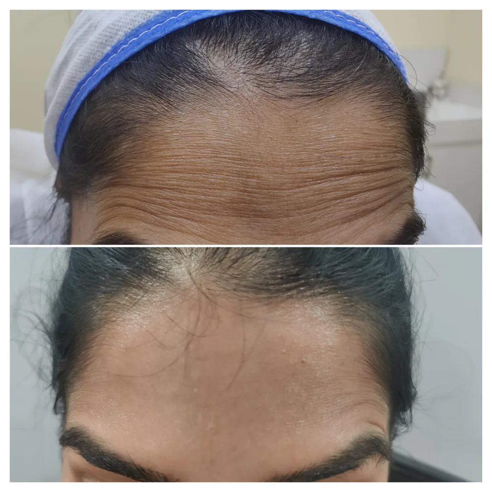 botox2