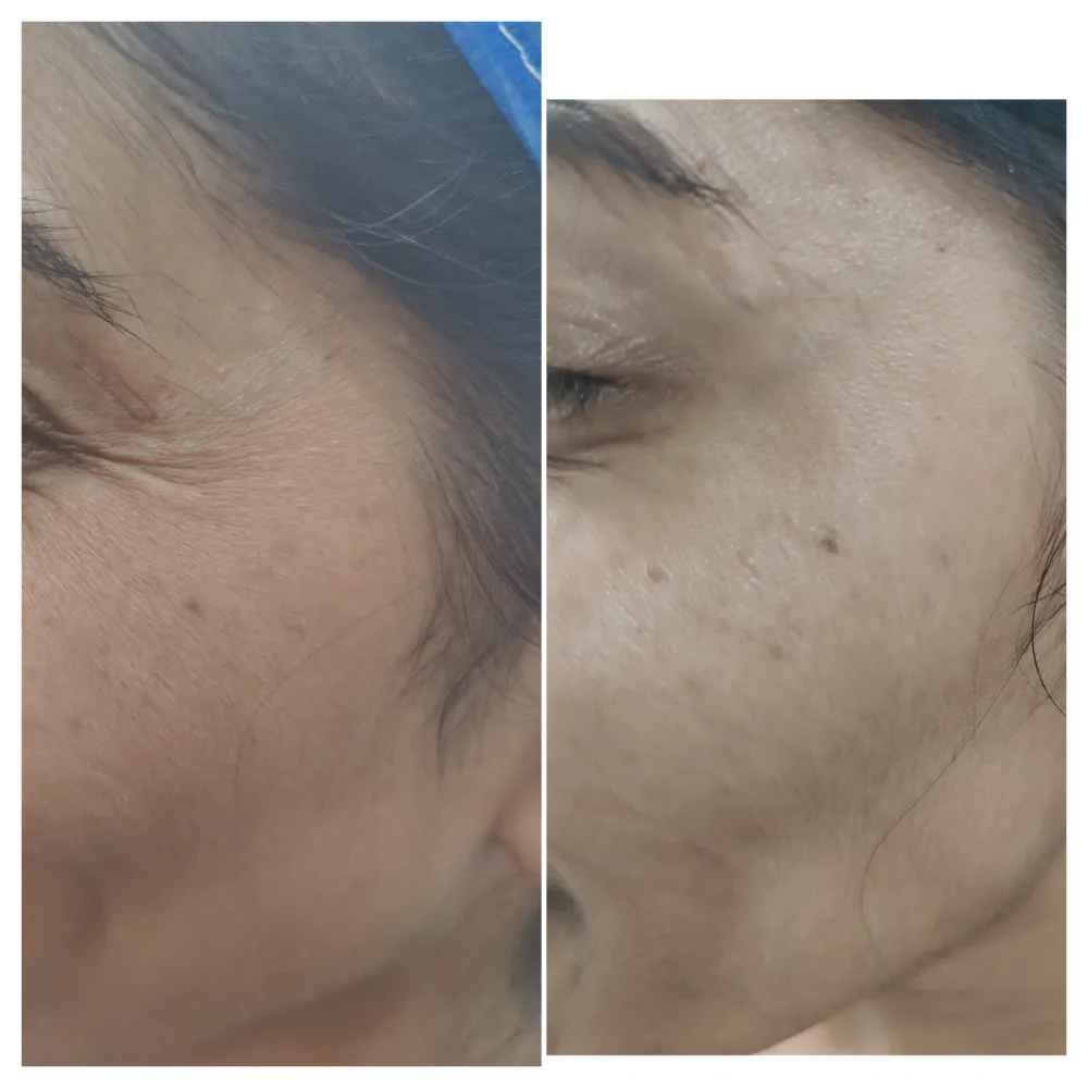 botox3