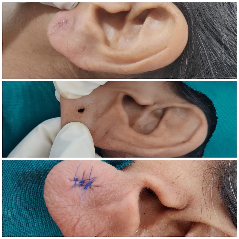 earlobe-repair